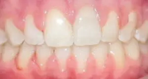 After braces