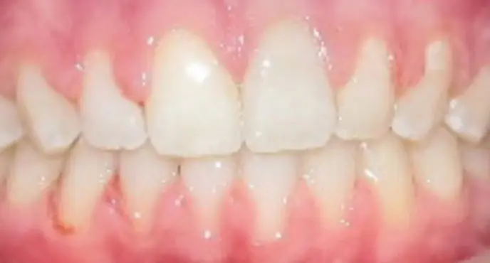 After braces