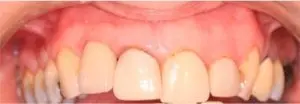 After tooth implant at Heaton Dental Care