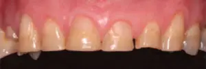 Teeth before crowns