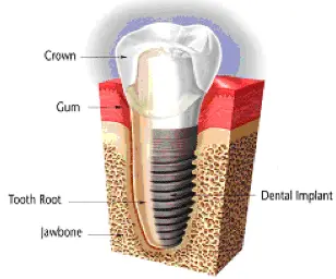 Dental implant diagram