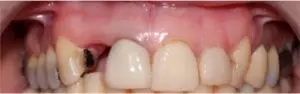 Before tooth implant