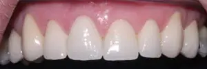 Teeth after crowns