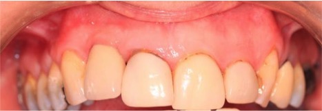 After tooth implant at Heaton Dental Care