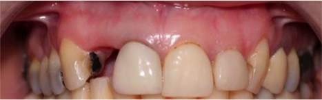 Before tooth implant